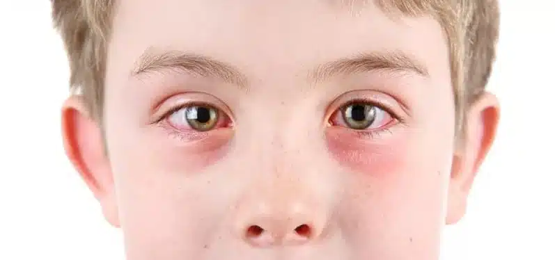 Eye Allergies Monterey CA