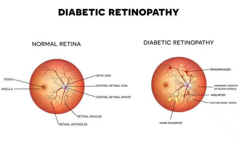 Diabetic Retinopathy Monterey CA