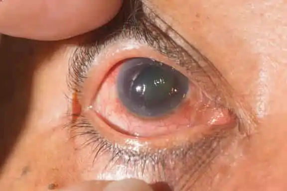 Glaucoma Monterey CA