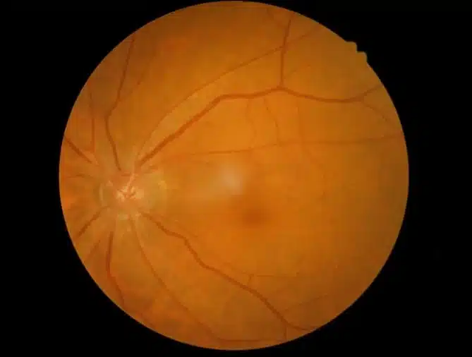 Macular Degeneration Monterey CA