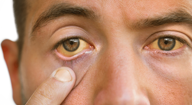 Man shows off his yellowed eyes.