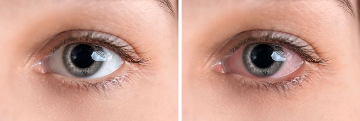 Uveitis